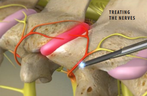 cervical-facet-radiofrequency