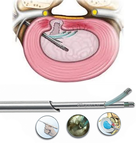 thermal-annuloplasty-endoscopic