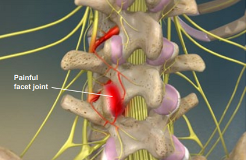 radiofrequency-neurotomy-of-the-lumbar-facets
