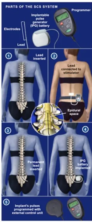 spinal-cord-stimulation