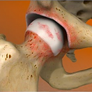 inflammatory-arthritis-of-the-hip