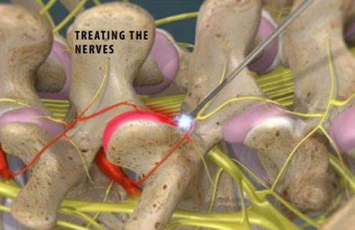 treating-the-nerves