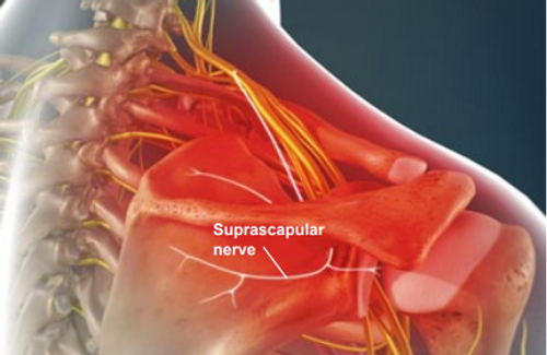 suprascapular-neuropathy