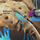 caudal-epidural-steroid-injection