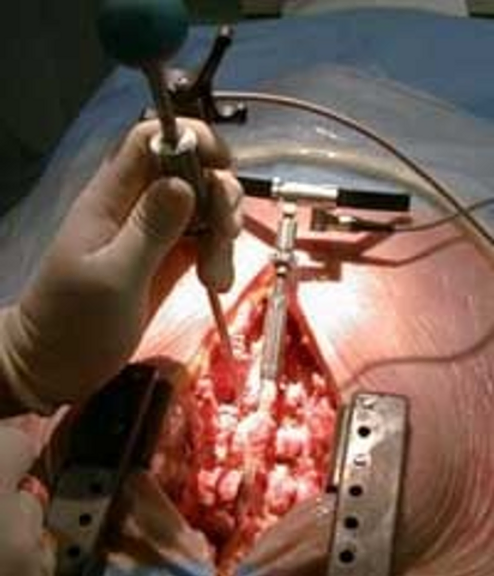 open-laminectomy-&-discectomy