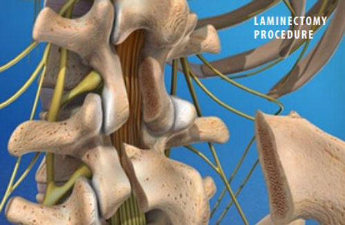 laminectomy-procedure