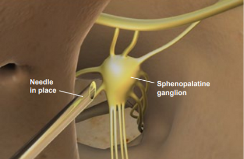 sphenopalatine-ganglion-block