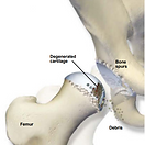 osteoarthritis-of-the-hip