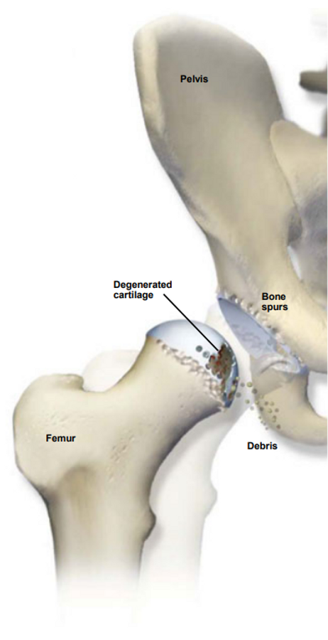 osteoarthritis-of-the-hip