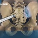 sacroiliac-joint-steroid-injection