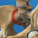 sacroiliac-joint-pain