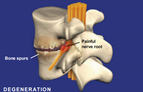 spondylosis