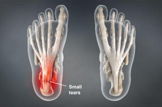 treatment-of-symptoms-of-plantar-fasciitis