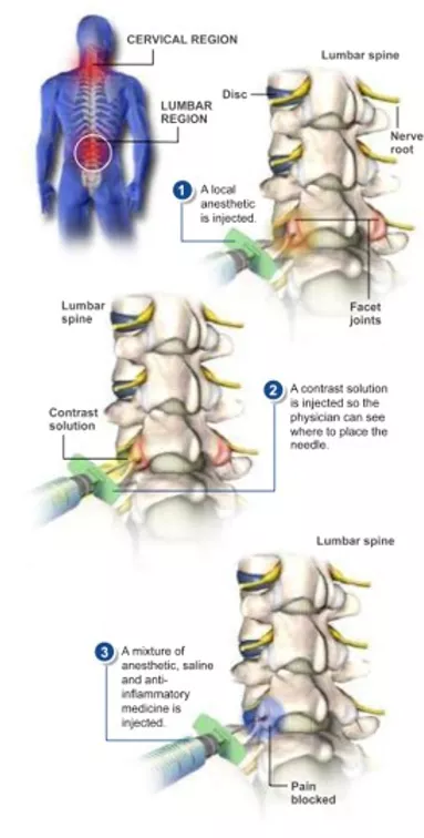 facet-joint-injection