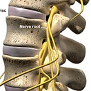 herniated-disc