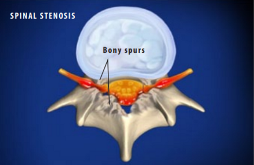 bony-spurs