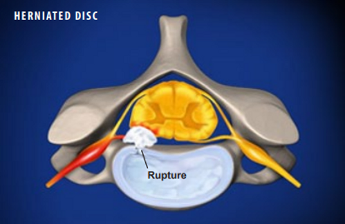 herniated-disc