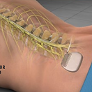 spinal-cord-stimulator-implant