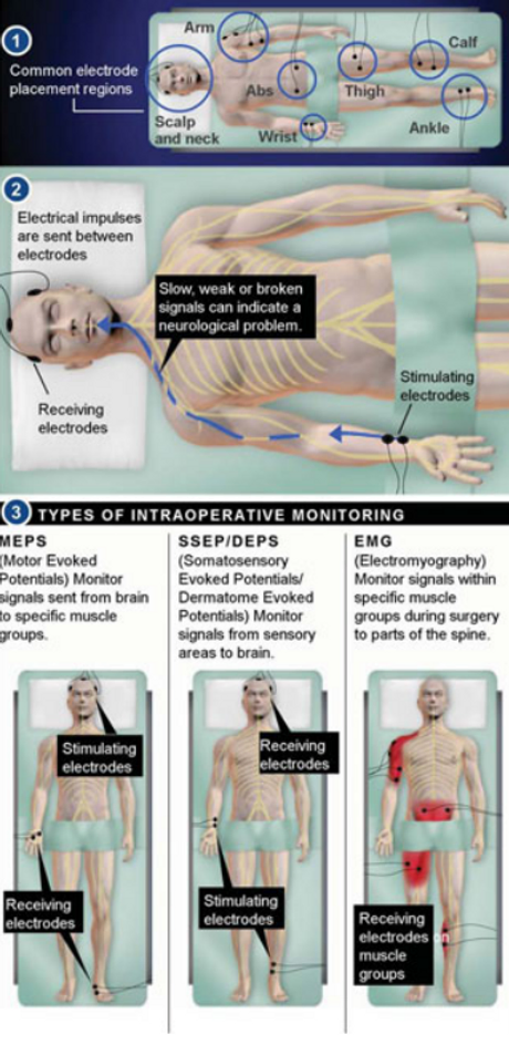 intraoperative-monitoring-of-the-nerves