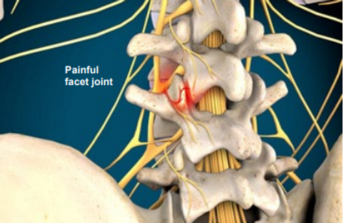 medial-branch-block