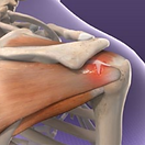 rotator-cuff-injuries