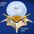 lumbar-radiculopathy