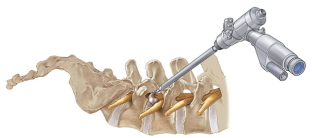 ultra-minimally-invasive