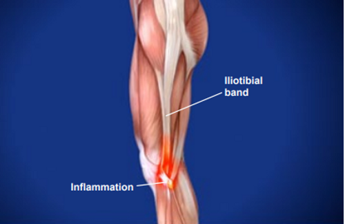 Iliotibial Band Syndrome (ITBS), Texas: Symptoms & Treatment