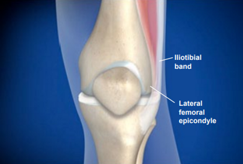 symptoms-of-iliotibial-band-syndrome