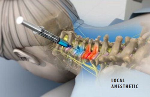 local-anesthetic