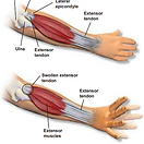 lateral-epicondylitis