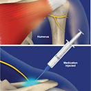 suprascapular-nerve-block