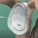 glenoid-labrum-tear