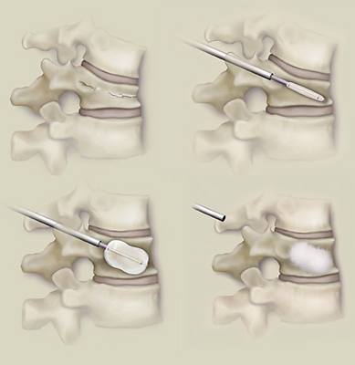 kyphoplasty-vertebroplasty​