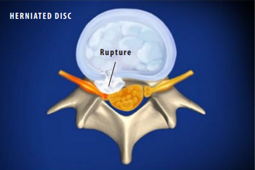 herniated-disc
