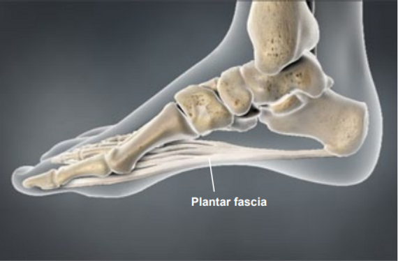 plantar-fasciitis