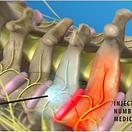 medial-branch-block