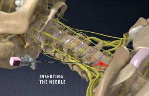 stellate-ganglion-block