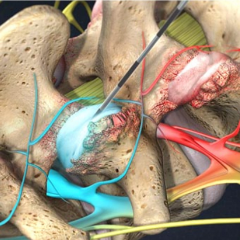 facet-joint-injections