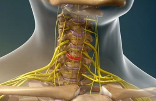 treatment-of-herniated-disc