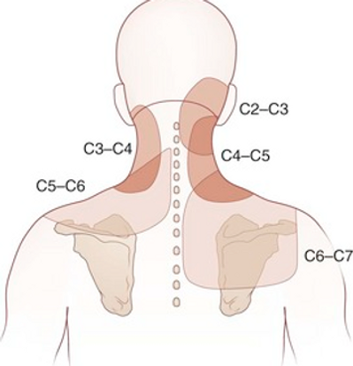 cervicogenic-headaches