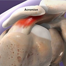 shoulder-impingement-syndrome