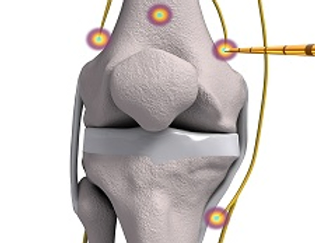 joint-radiofrequency-neurotomy