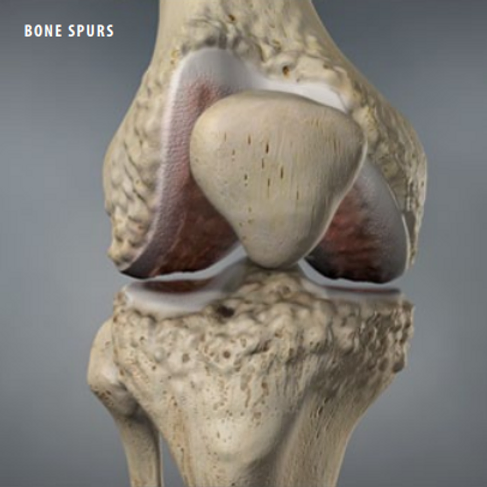 bone-spurs