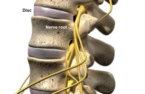 herniated-disc