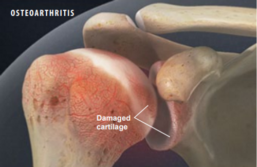 shoulder-osteoarthritis