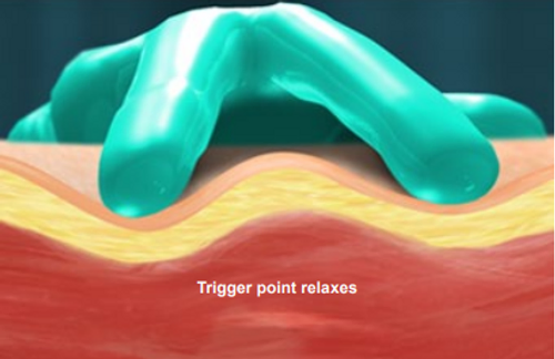 trigger-point-injection