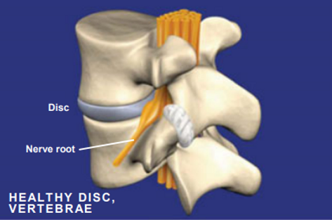 spondylosis