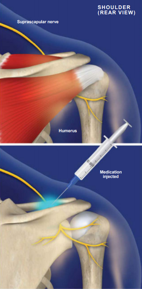 suprascapular-nerve-block