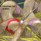 radiofreq-neurotomy-lumbar-facets